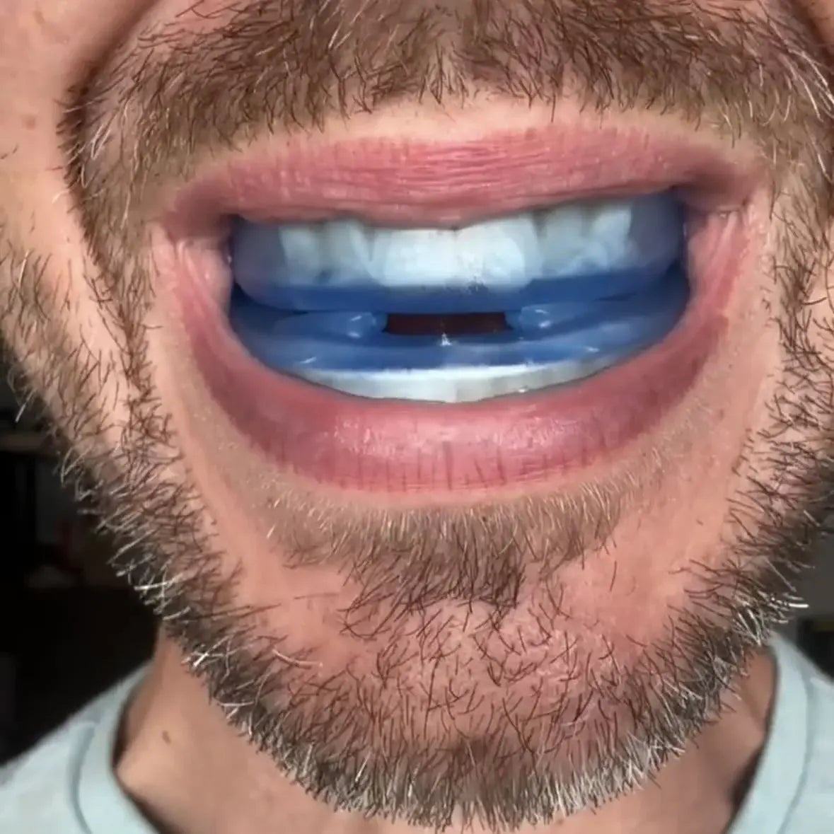 SilentGuard™ Anti-Snoring Mouthpiece