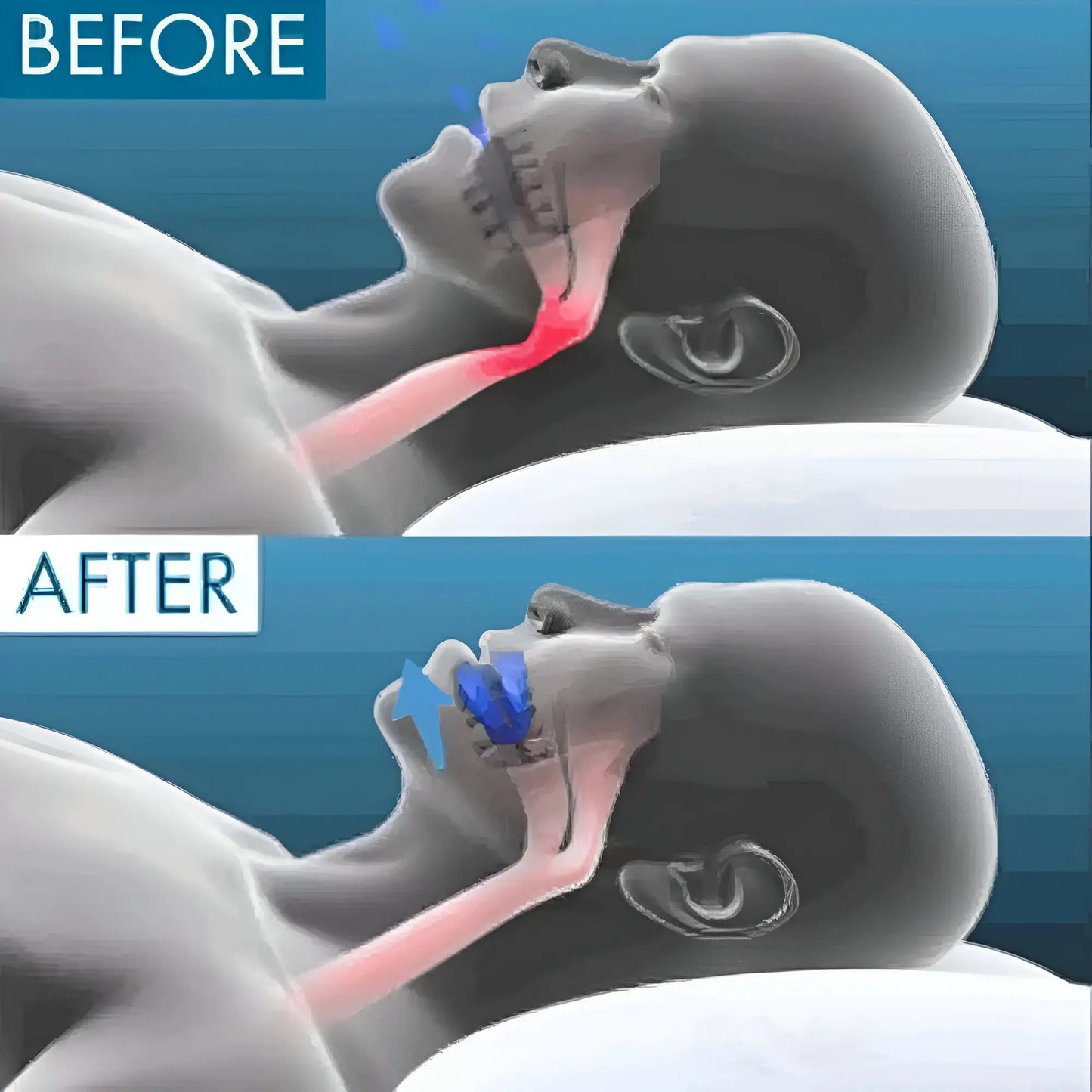 SilentGuard™ Anti-Snoring Mouthpiece