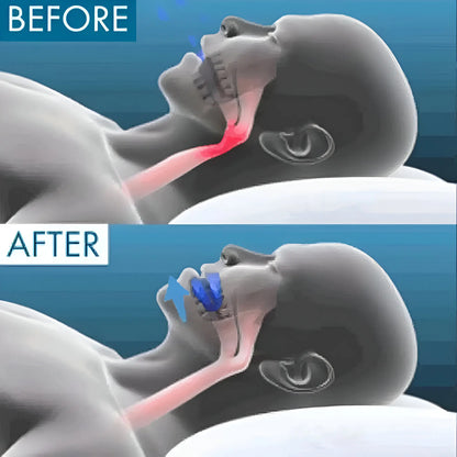 SilentGuard™ Anti-Snoring Mouthpiece